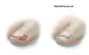 ingrown toenail onychocryptosis known also ingro